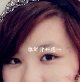 迁移宫有痣